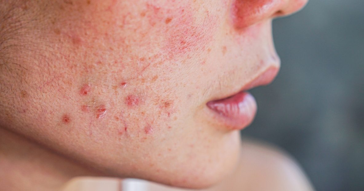 do lack of sleep cause acne, A close-up of a person's cheek with inflamed acne, redness, and blemishes, possibly linked to lack of sleep.